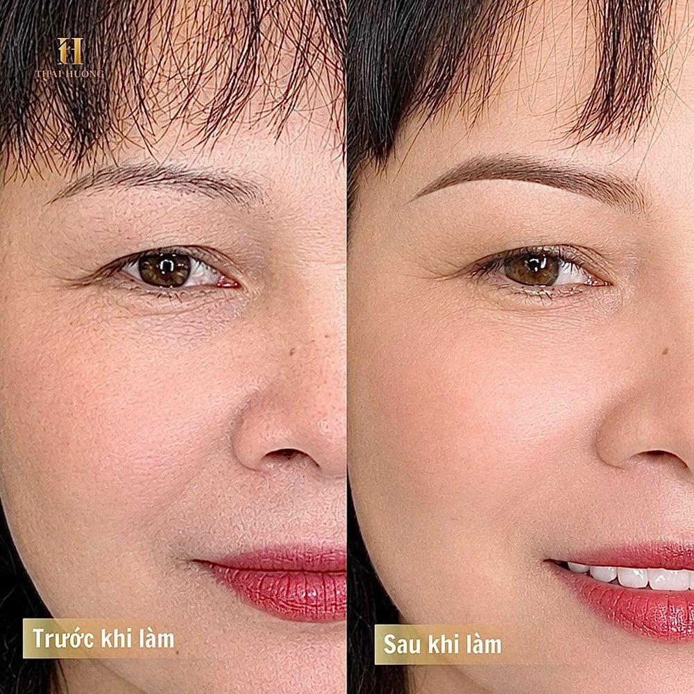 Xóa sửa mày hỏng trước và sau